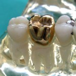 gold crown, dental crown, crown