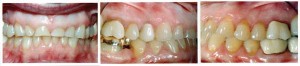 Acid erosion of teeth Â© PennWell Corporation